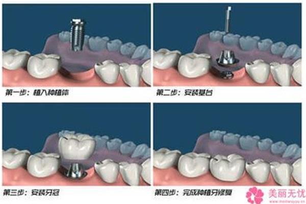 种植牙需要多少钱