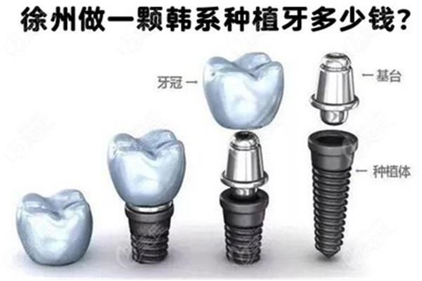 种植牙一颗大概多少钱