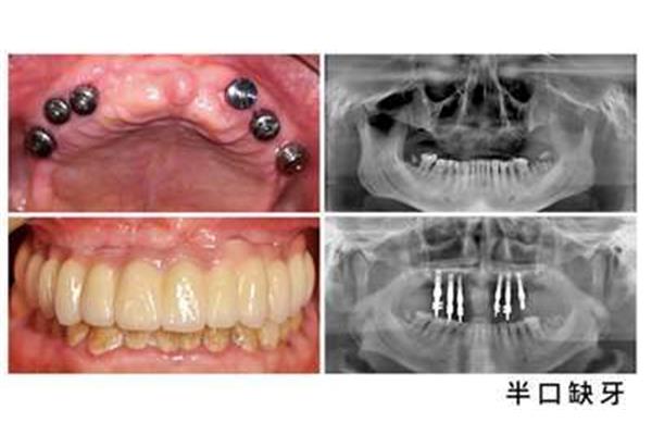 满口牙种植多少钱